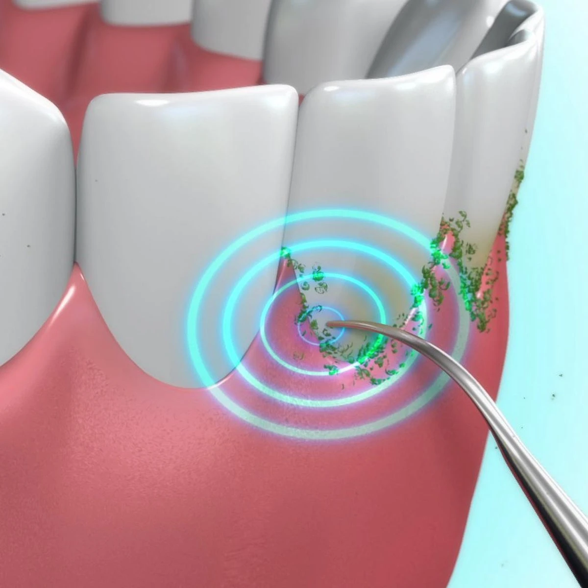 Toppers Van TV - Sonic Tandsteenverwijderaar - Tandplakverwijderaar - Afbeelding 6