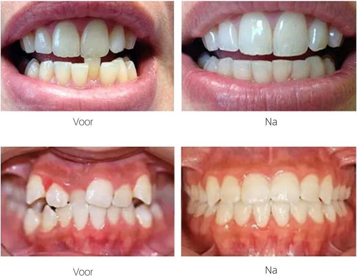Edoir Rechte Tanden Beugel - Retainer Voor Rechte Tanden - Rechte Tanden Bitje - Afbeelding 6